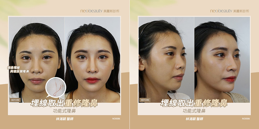 功能式隆鼻