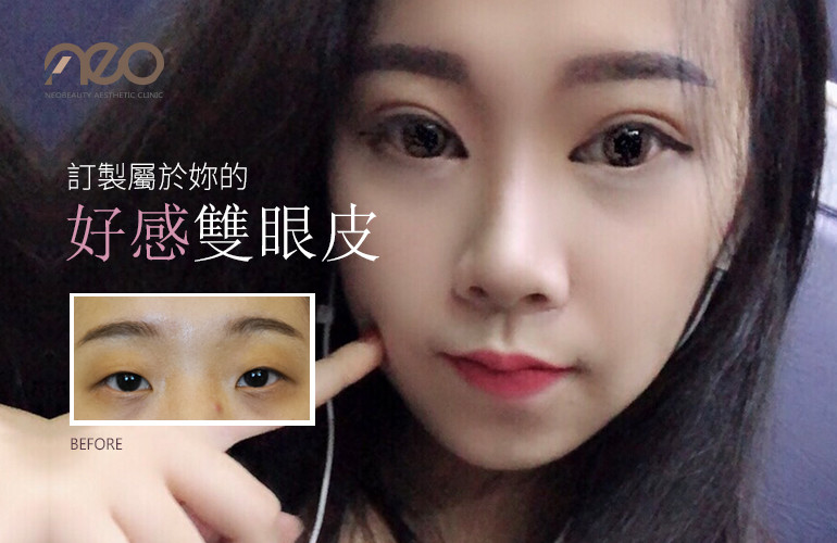 娃娃眼雙眼皮手術介紹