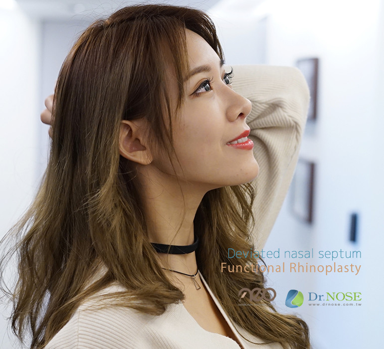 隆鼻、鼻重修、二次隆鼻