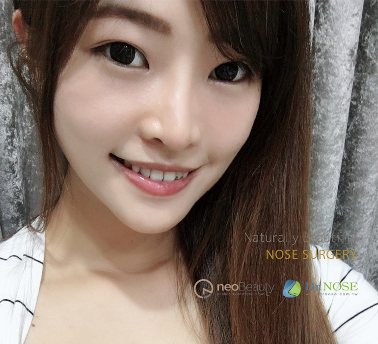 隆鼻感染重建，二次隆鼻找回笑容