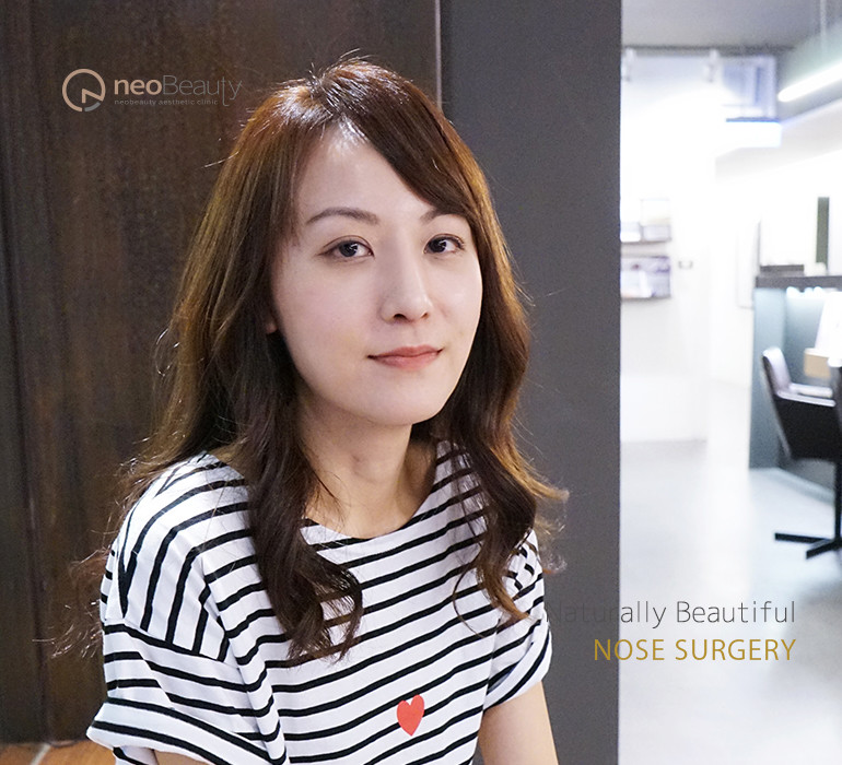 鷹勾鼻女孩矯正隆鼻，學習更欣賞自己