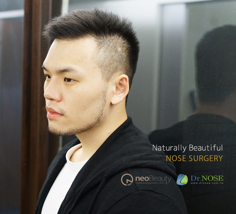男性隆鼻，讓鼻型有自己的個性
