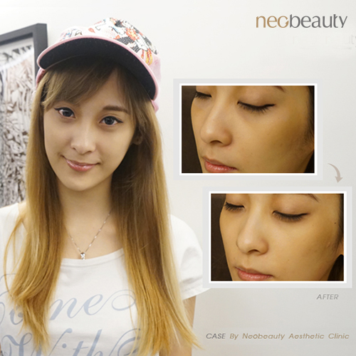 脈衝式二極體雷射，美女魔術師王子妃給人好臉色看